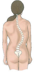 Escoliose