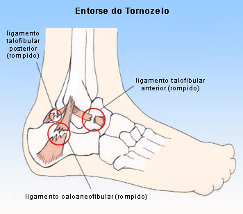 Entorse