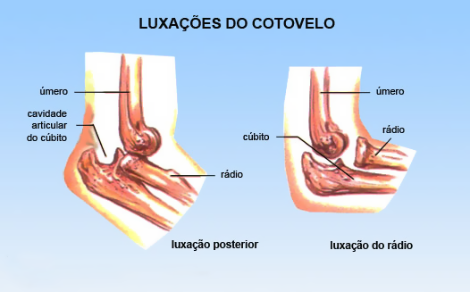 Luxação